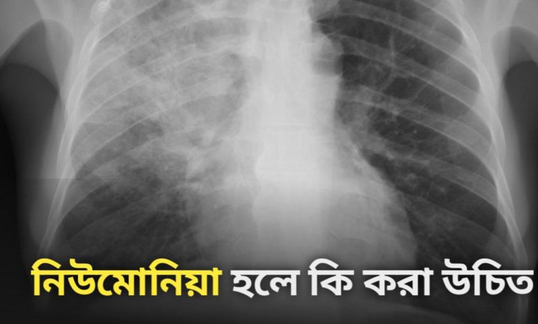 Pneumonia