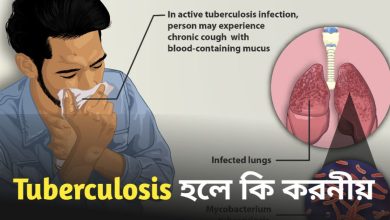 Tuberculosis