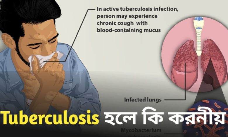 Tuberculosis