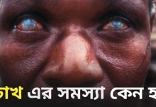 Eye