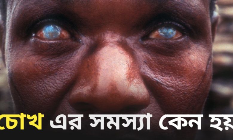 Eye