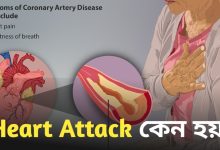 Heart Attack