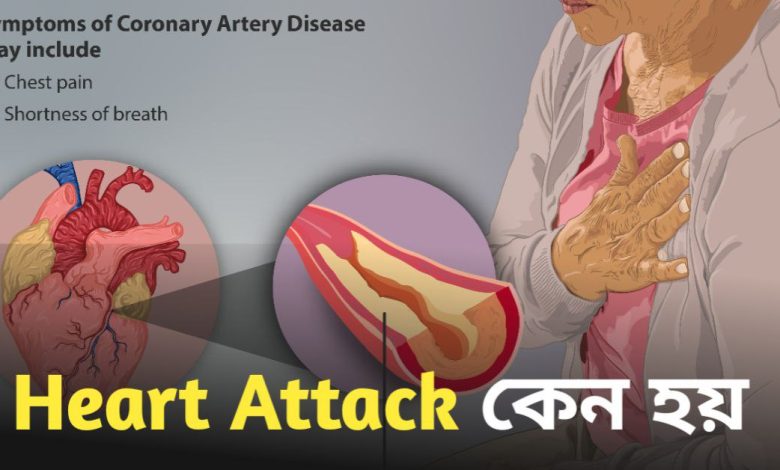 Heart Attack