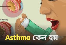 Asthma