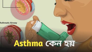 Asthma