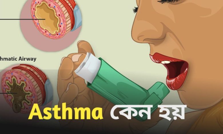 Asthma