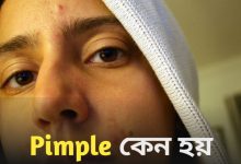 Pimple