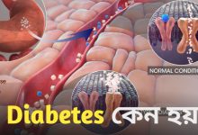 Diabetes