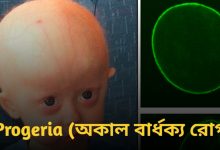 Progeria