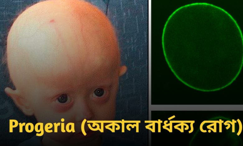 Progeria