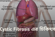 Cystic Fibrosis