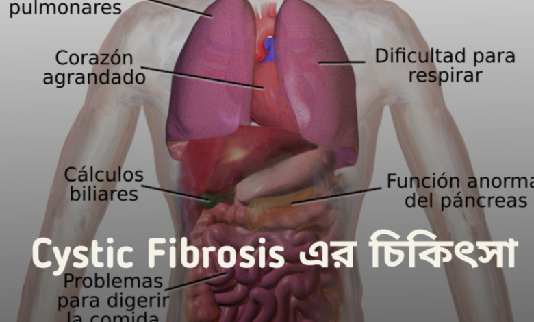 Cystic Fibrosis
