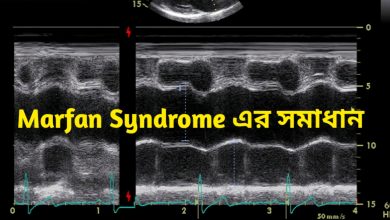 Marfan Syndrome