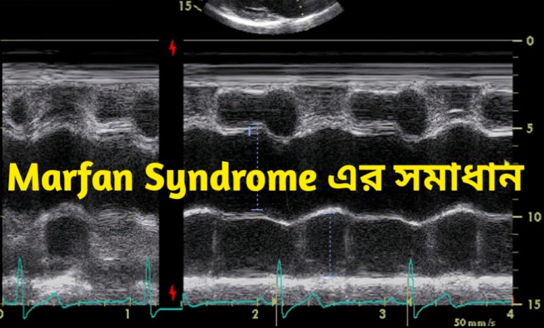 Marfan Syndrome