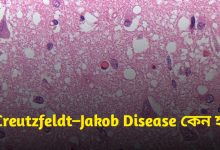 Creutzfeldt–Jakob Disease