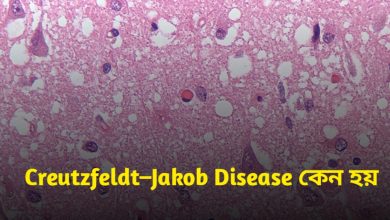 Creutzfeldt–Jakob Disease