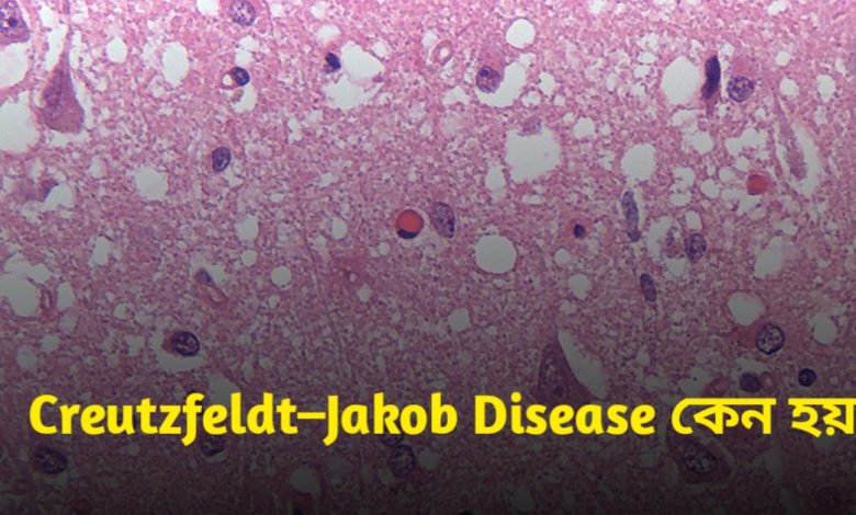 Creutzfeldt–Jakob Disease