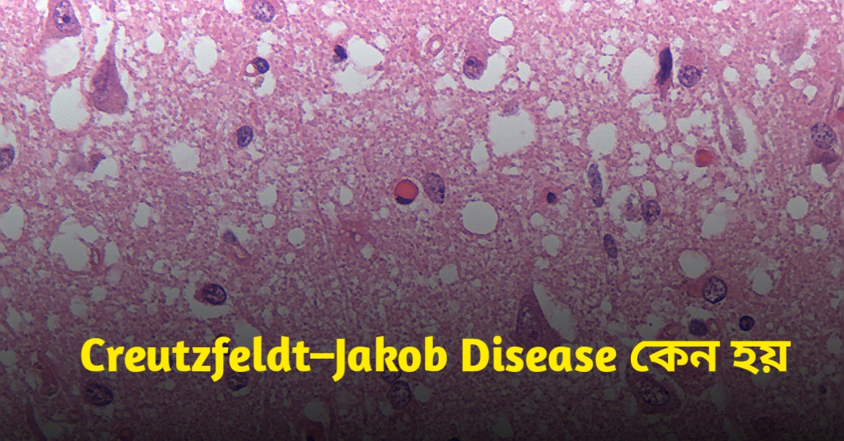 Creutzfeldt–Jakob Disease